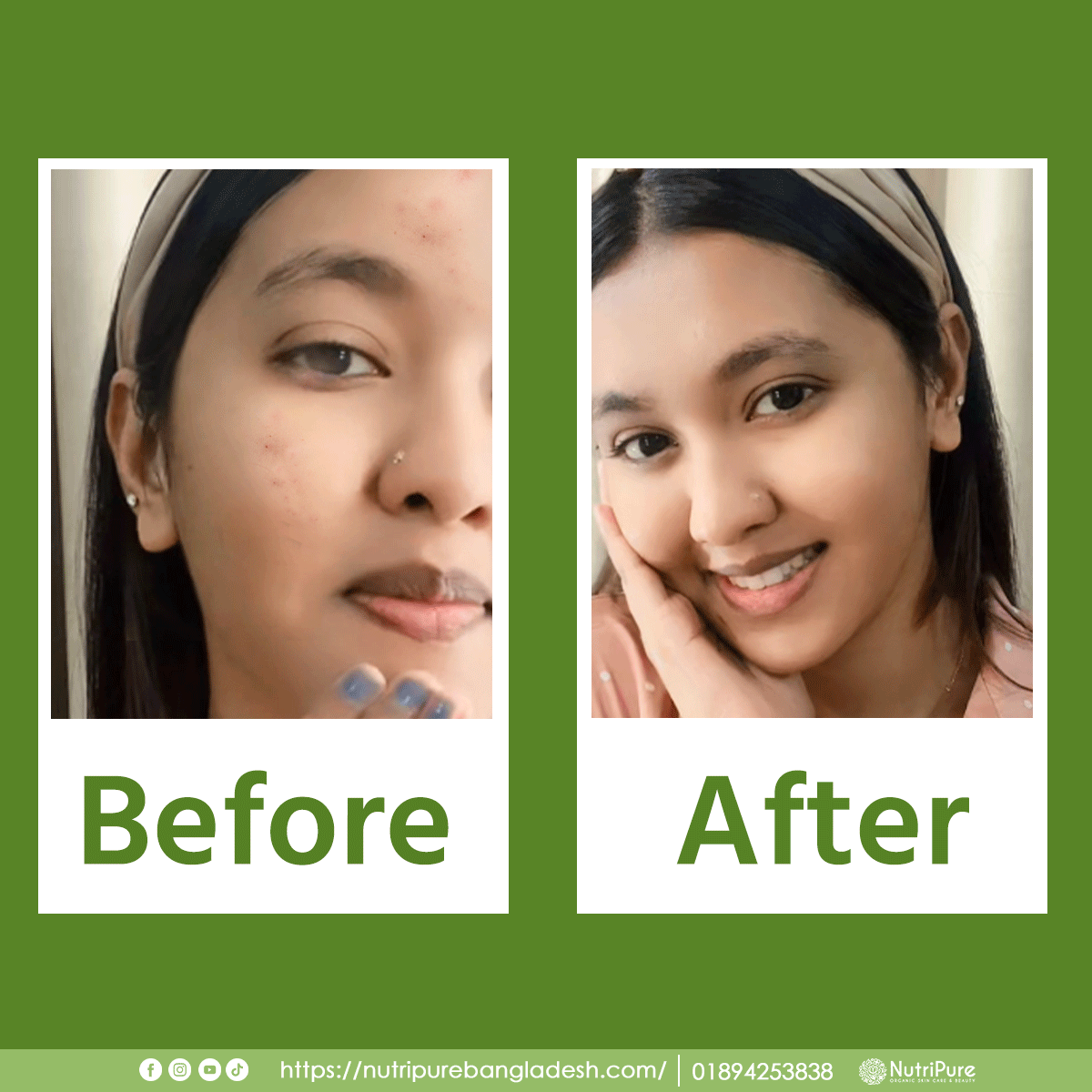 Quick Acne Treatment Mask My Store