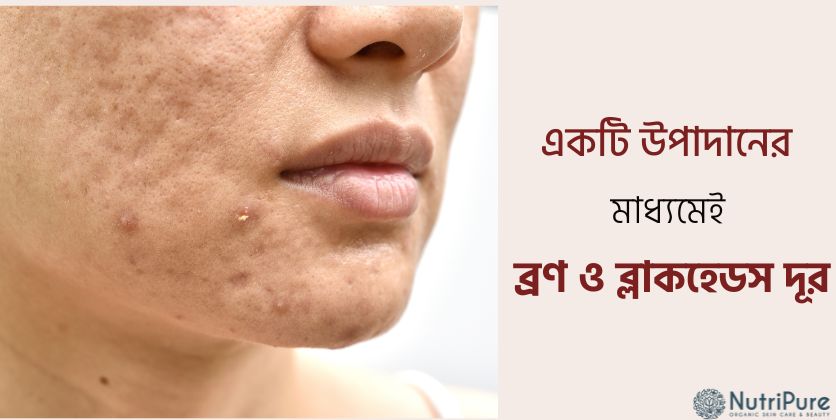 মাত্র একটি উপাদানের মাধ্যমেই  ব্রণ, ব্ল্যাকহেডস ও ত্বকের রুক্ষতা দূর হবে । Just one ingredient can eliminate acne, blackheads, and skin roughness.