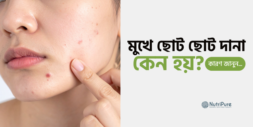 মুখে ছোট ছোট দানা কেন হয়? কারণ জানুন Why do tiny bumps appear on the face?