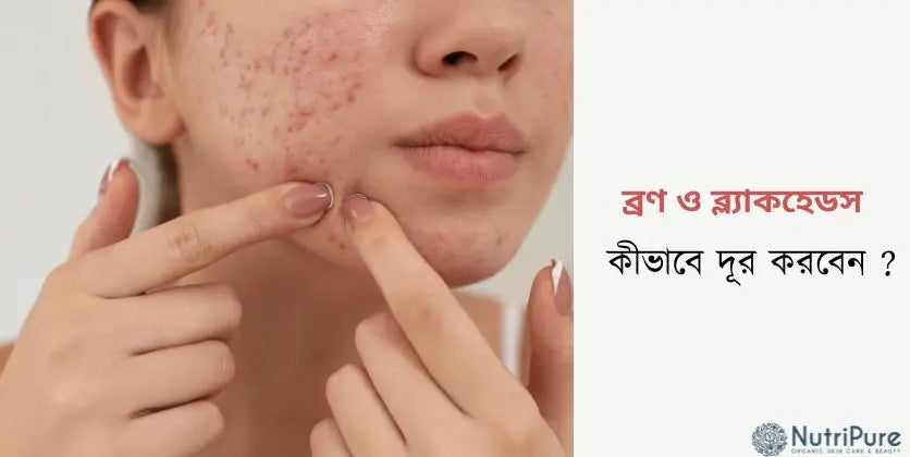 মাত্র একটি  উপাদানে ব্রণ, ব্ল্যাকহেডস ও ত্বকের রুক্ষতা দূর