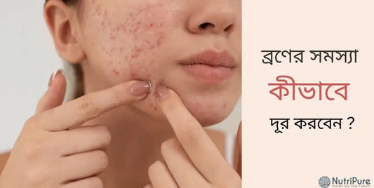 ব্রণের সমস্যা কীভাবে দূর করবেন ?